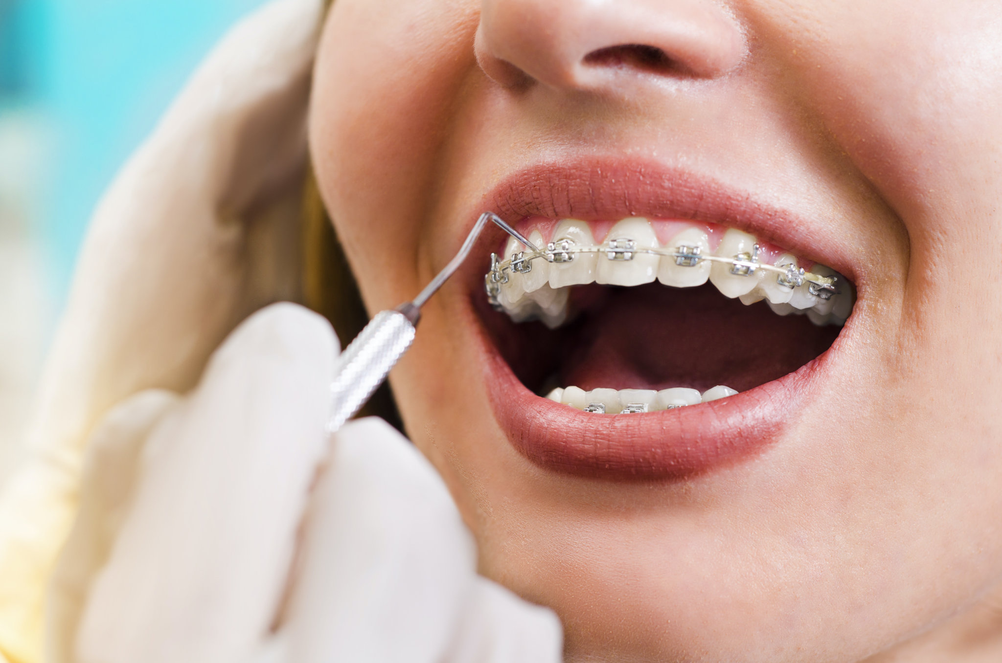 Which Type of Braces Are the Most Comfortable?