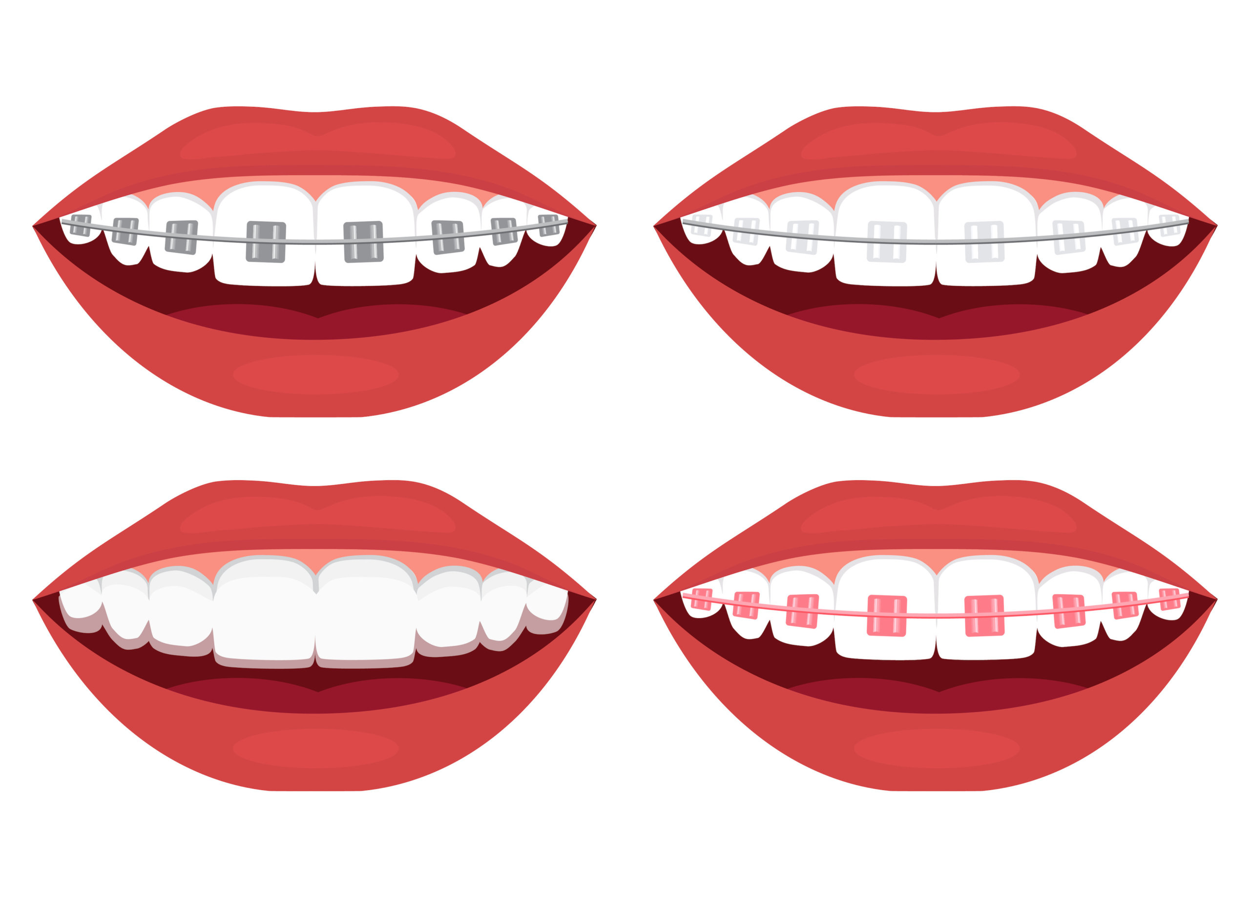 Lingual braces vs Ceramic braces